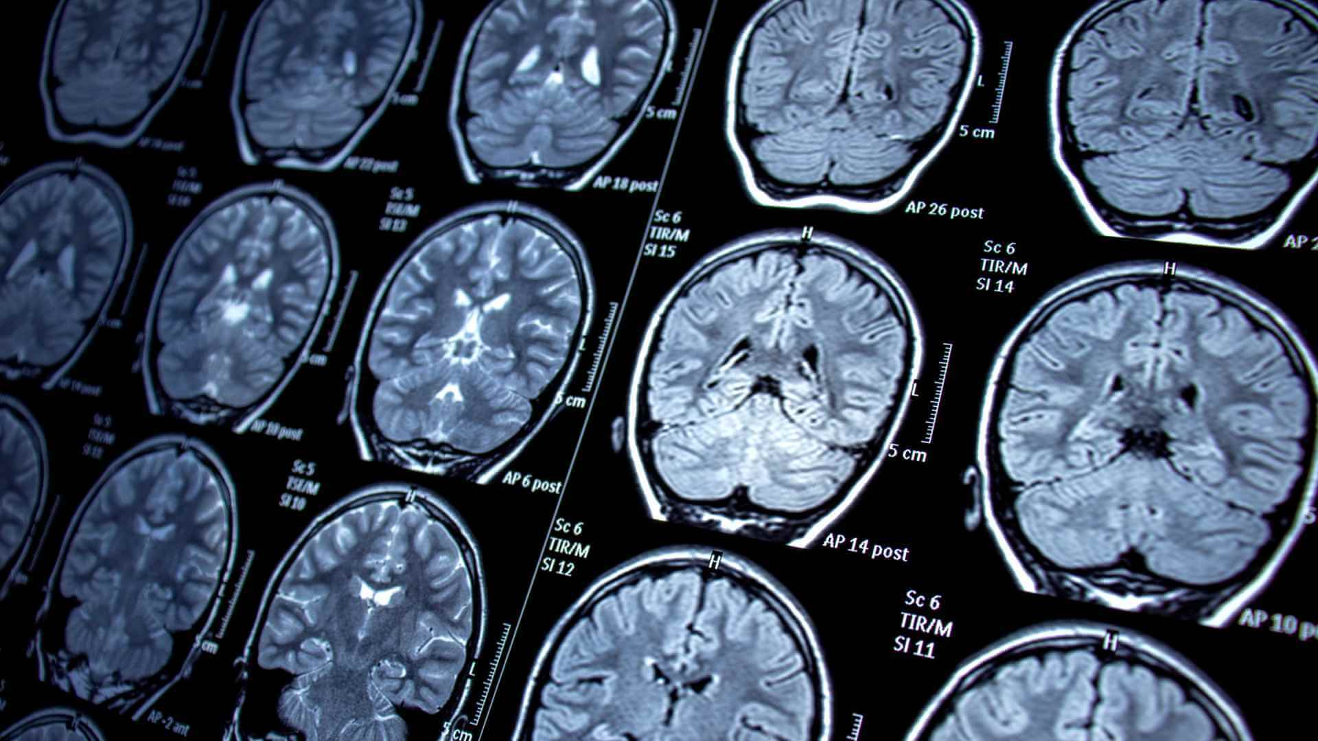 Recuperare neurologică și antrenament funcțional la RecuNova